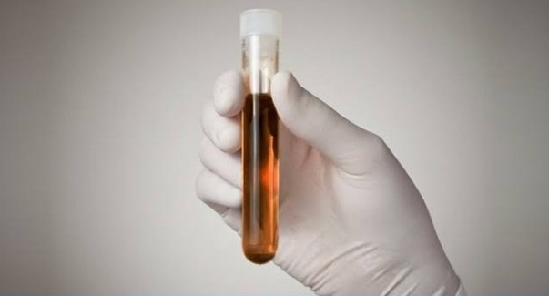 Rabdomiólise: tudo o que você precisa saber sobre a doença da ‘urina preta’