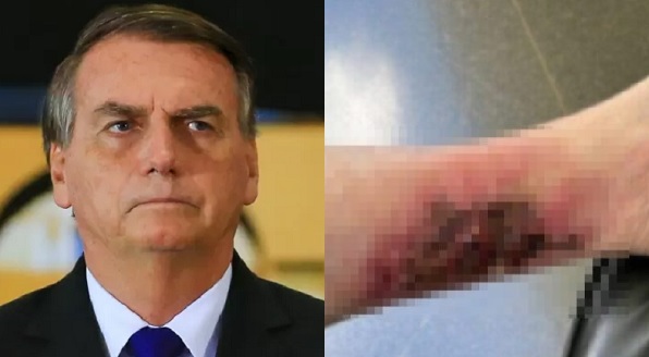 Carlos Bolsonaro divulga foto da perna de Bolsonaro com uma grande ferida proveniente de doença infecciosa